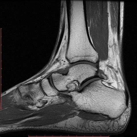 Posterior Ankle Impingement Image