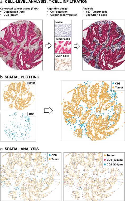 Spatial Analysis Of Tumor Immune Cell Infiltration A Colorectal