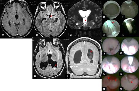 Illustrative Cases Of Endoscopic Management Of Intraventricular Ncc Download Scientific