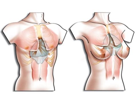 What Are Pectus Excavatum Implants How Are They Made