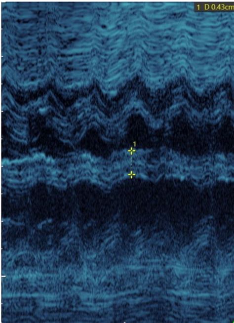 Figure From Interventricular Septal Thickness As A Diagnostic Marker