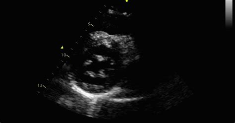 Echovar Eco Del Dia Displasia Valvular Mitral A Proposito De Varios Casos