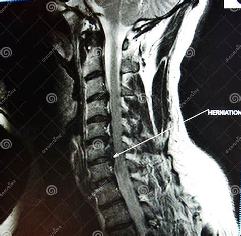 Mri of Cervical Spine Stenosis Stock Image - Image of inability ...