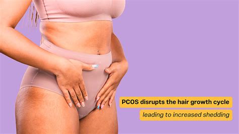 Understanding And Treating Hair Loss Caused By Pcos In Women Ashley And Martin Singapore