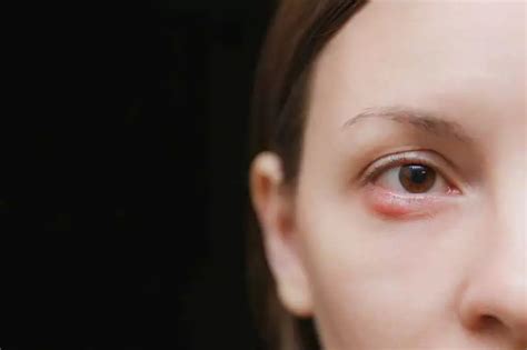 Ječmenac na oku: koji su uzroci, simptomi i liječenje! | Dioptrija.hr