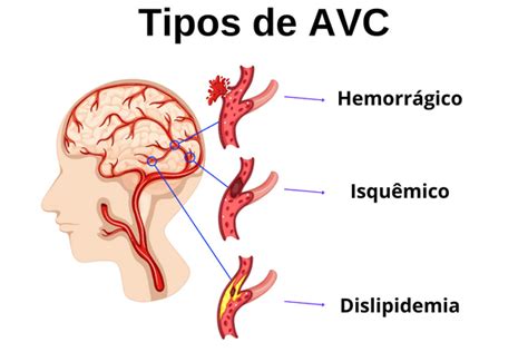 Avc Isquêmico E Hemorrágico O Que é Causas E Sequelas