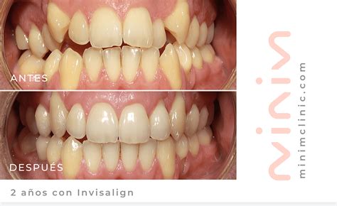 Antes y Después con Invisalign Adultos MINIM