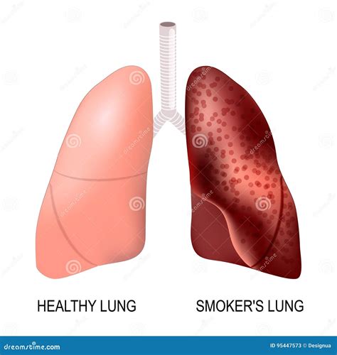 Healthy Lungs And Smokers Lungs Stock Vector Illustration Of Lungs