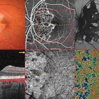 Multimodal Imaging Of The Left Eye Of A 32 Year Old Woman With