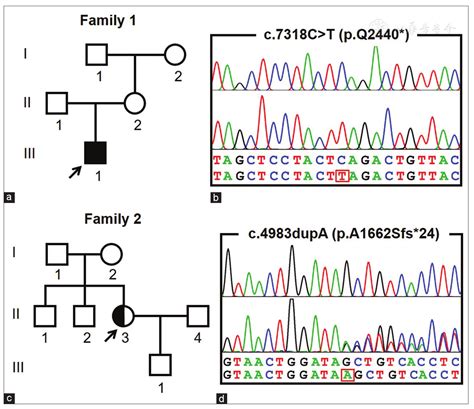 A De Novo Mutation In Dystrophin Causing Muscular Dystrophy In A Female