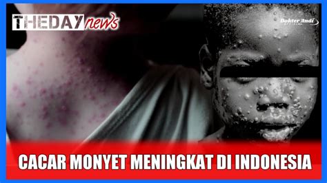 Kasus Mpox Cacar Monyet Di Indonesia Meningkat Youtube