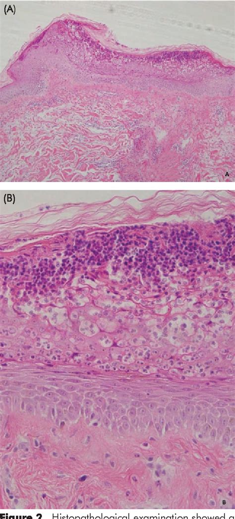 Acute Generalized Exanthematous Pustulosis Histology