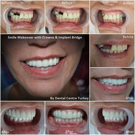 Spicy Dental Bridge Types Of Toothfairytime DentalBridgeOther