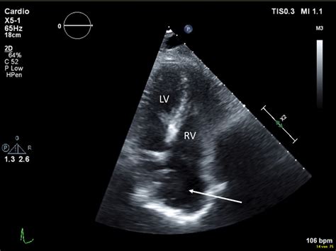 Atrial Septal Defect Mimicking Right Atrial Myxoma Circulation