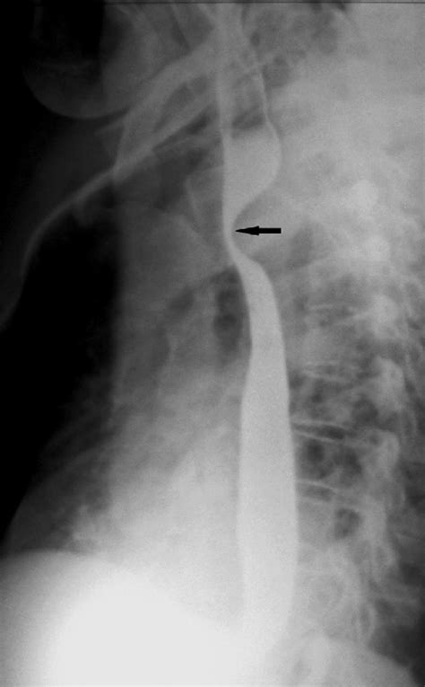 Normal Barium Swallow Anatomy