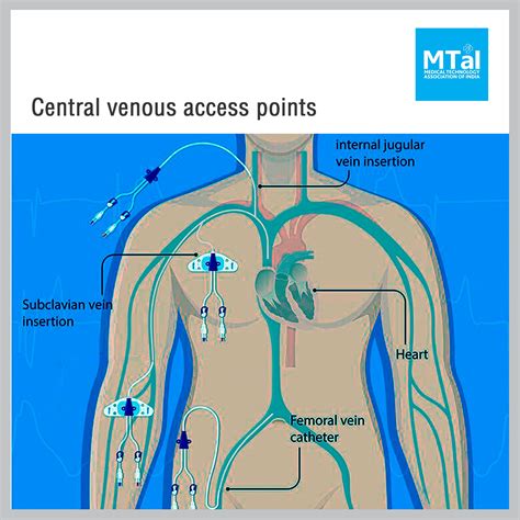 Central Venous Catheter Subclavian