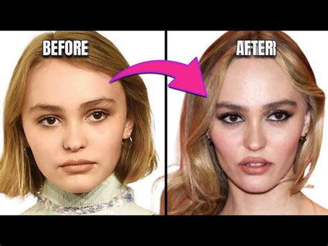 Depp Plastic Surgery