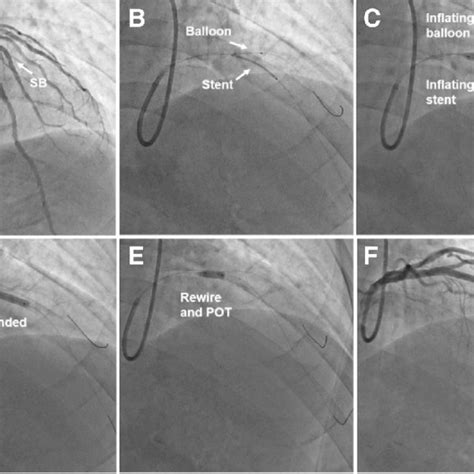 Pdf Modified Balloon Stent Kissing Technique Avoid Side Branch