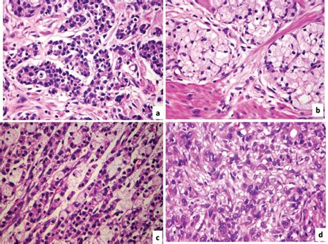 Gastric Composite Tumor A Mixed Adenocarcinoma And Neuroendocrine