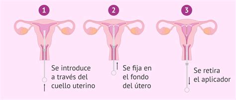 Diu Tipos Ventajas y Desventajas Un Análisis Completo sobre sus