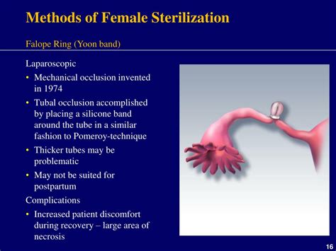 Ppt Female Sterilisation Powerpoint Presentation Free Download Id