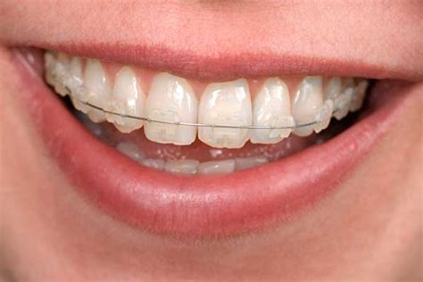 Clear And Metal Braces Orthodontic Services