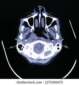 Transverse Axial Plain Ct Scan Showing Stock Photo 655950424 Shutterstock