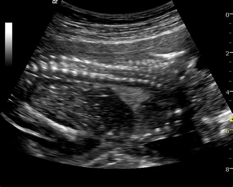 Echogenic Bowel 2 Vessel Cord