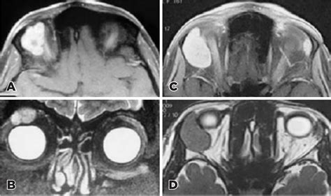 SciELO Brasil Clinical And Radiologic Outcomes Of Pleomorphic