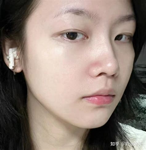 为什么做完医美项目后，强烈建议要做好修护？ 知乎