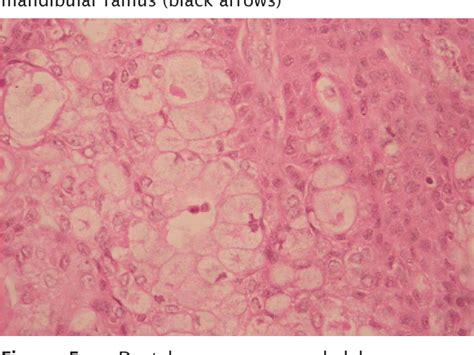 Figure 1 From Intraosseous Mucoepidermoid Carcinoma Of The Mandible A Rare Case Report