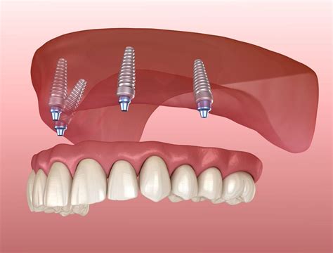 Types Of Dentures Their Costs Complete Denture Care Tips