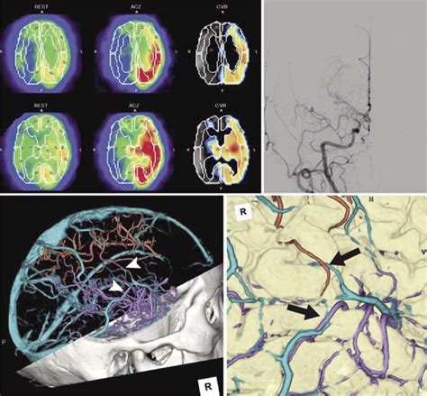 A Regional Cerebral Blood Flow RCBF At Rest Was Approximately 40