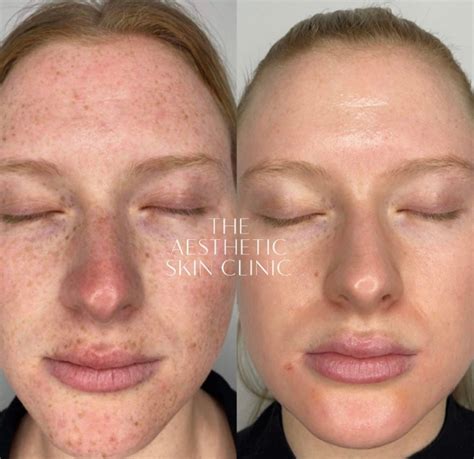 Pigmentation Sun Damage Theaestheticskinclinic