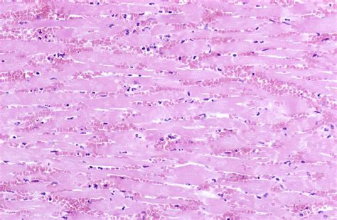 ST Elevation Myocardial Infarction Histopathology Wikidoc