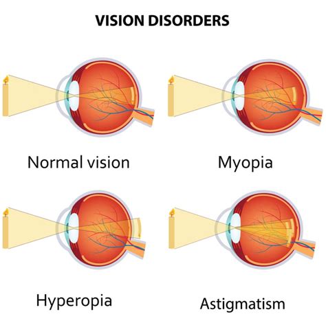 Lasik Surgery