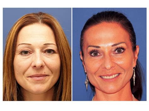 Botulinumtoxin Botox Krähenfüsse Zornesfalten Faltenbehandlung