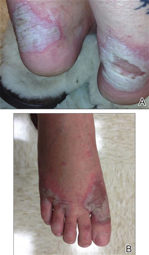 Acrodermatitis Enteropathica From Zinc Deficient Total Parenteral