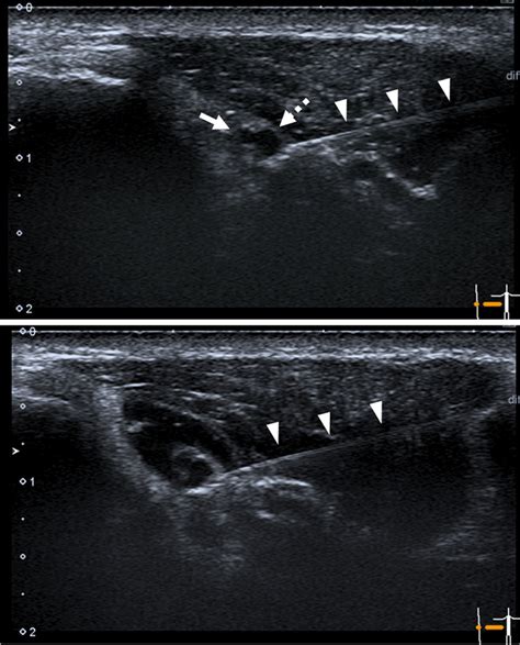 Ultrasound Us Image Of Us Guided Sciatic Nerve Blocks Two Components