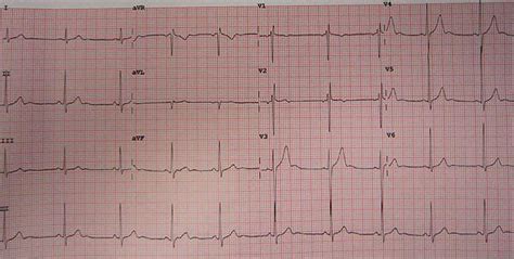 Benign ductal ectasia | General center | SteadyHealth.com