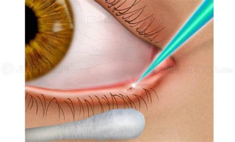 Laser Punctal Occlusion Sude0001 Stock Eye Images