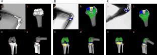 Bicruciate Retaining Total Knee Arthroplasty Procedure Reduced Tensile