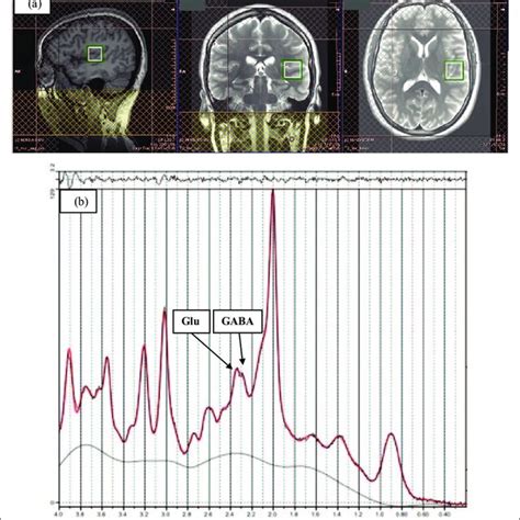 A Example Of H Mrs Voxel Placement In The Left Superior Temporal