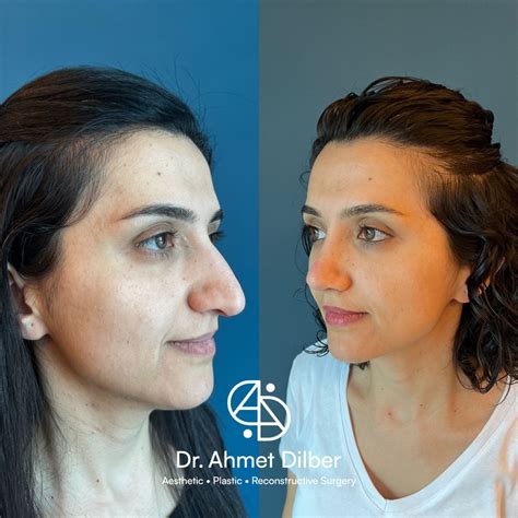 Rhinoplasty Result Dr Ahmet Dilber Rhinoplasty Nose Jobs