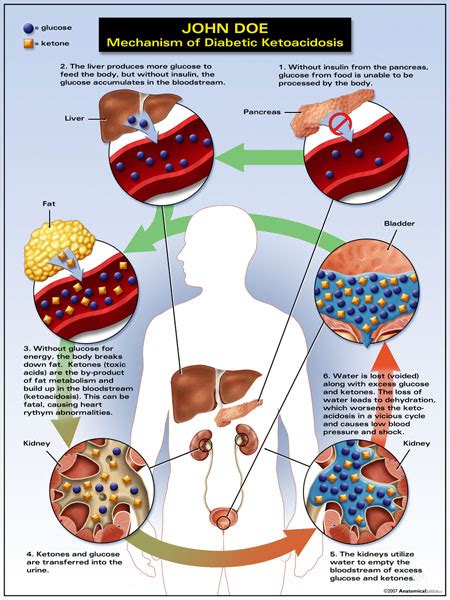 What Is Diabetic Ketoacidosis Dka 4 Definition