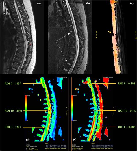 Role Of Diffusion Tensor Imaging And Tractography In Spinal Cord Injury