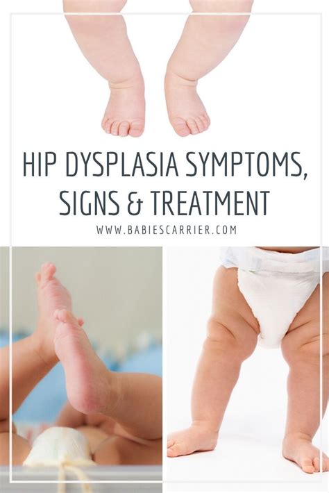 Infant Hip Dysplasia Do Baby Carriers Cause Hip Dysplasia Hip