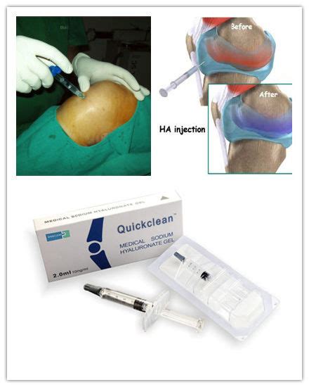 China Quickclean Sodium Hyaluronate Gel Bone Joint Injection China Sodium Hyaluronate Gel