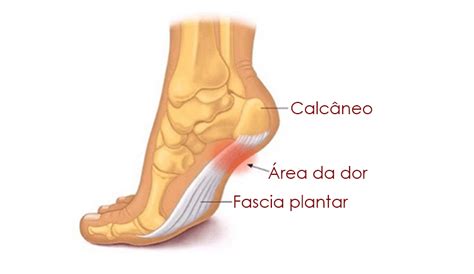 Fascite Plantar O Que é Quais Os Sintomas Como Acabar Com As Dor