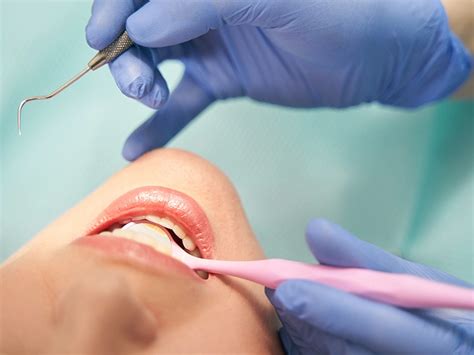 How Long Does Tooth Filling Last And How To Extend Lifespan Dental